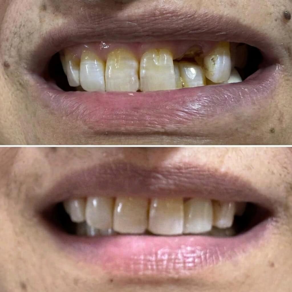 Broken Teeth Restoration Before and After