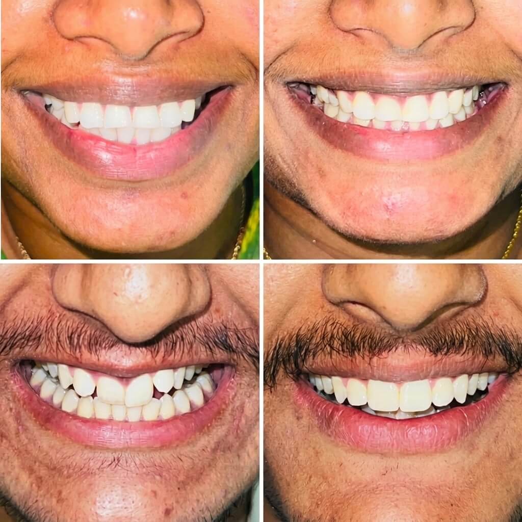 Teeth Crowding Fix Before and After