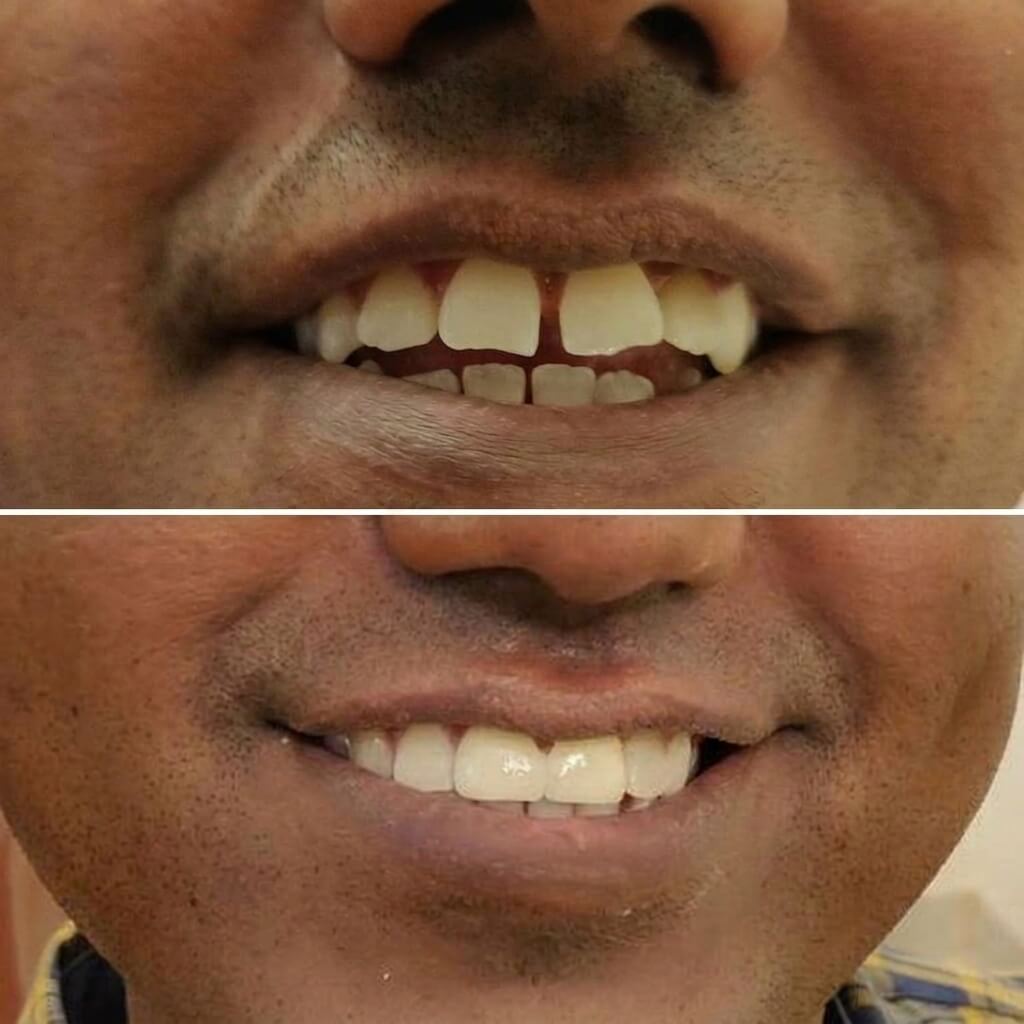 Teeth Gap Closure Before and After