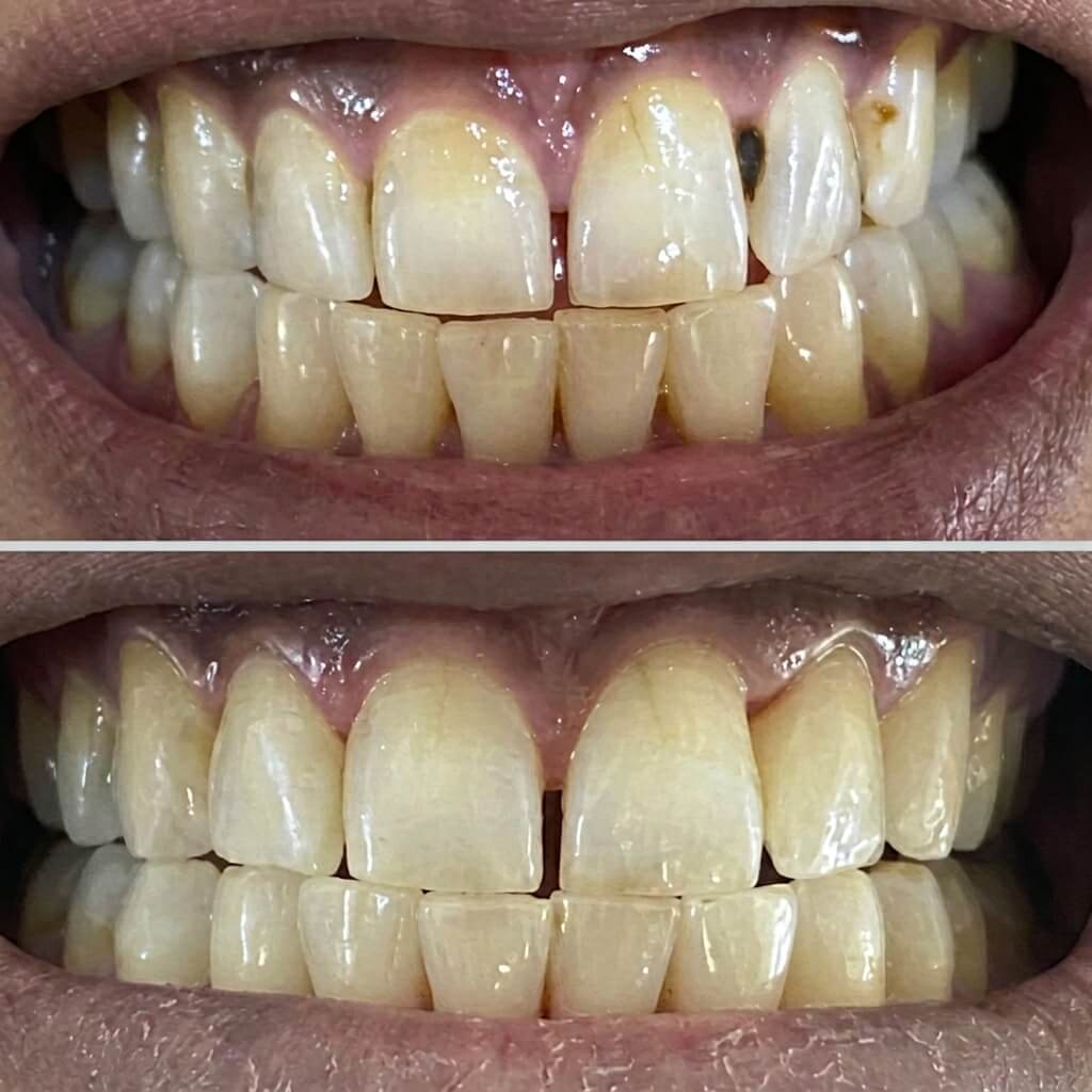 Teeth Whitening Before and After